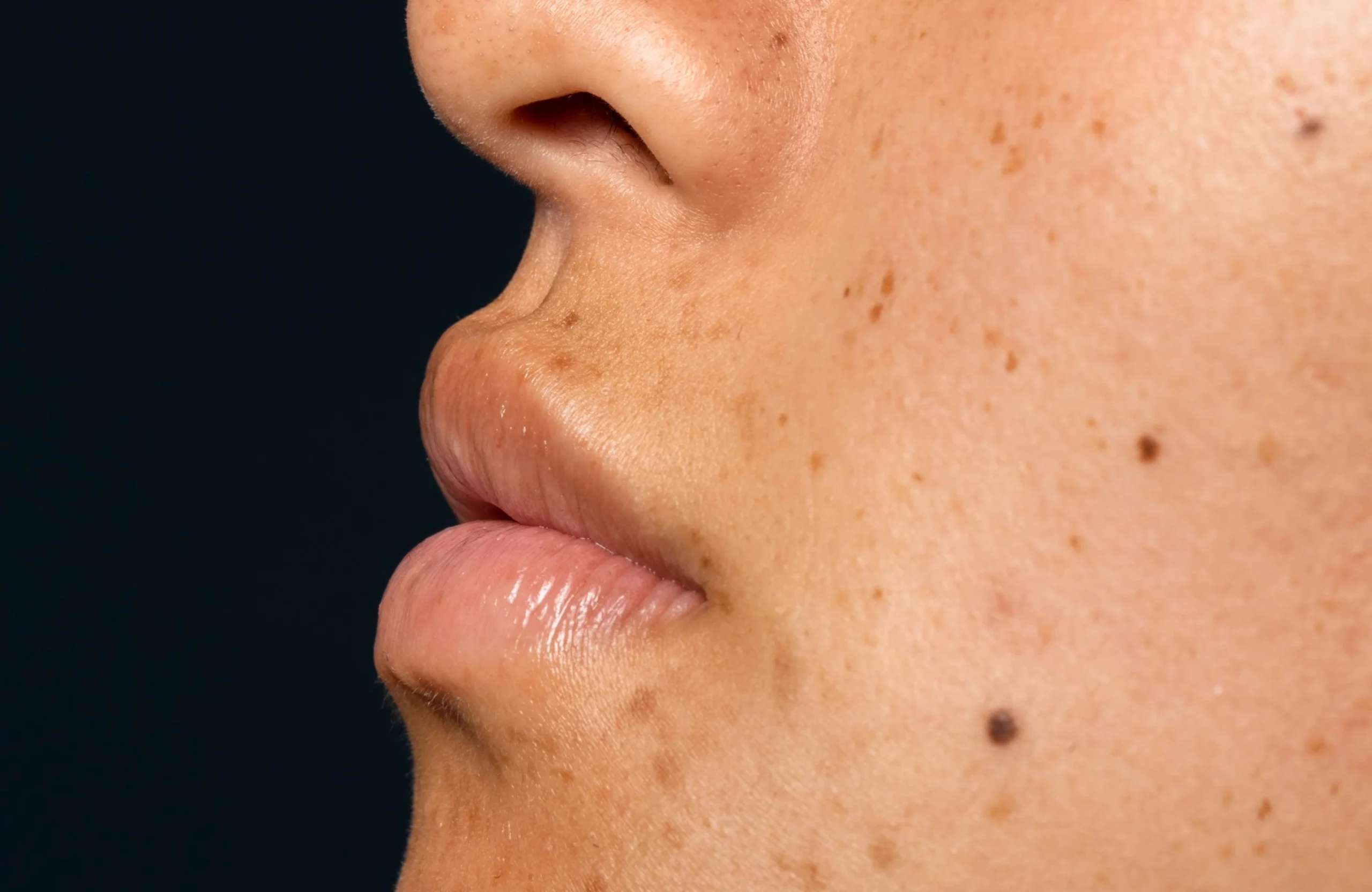 Melasma Treatment in Sainikpuri