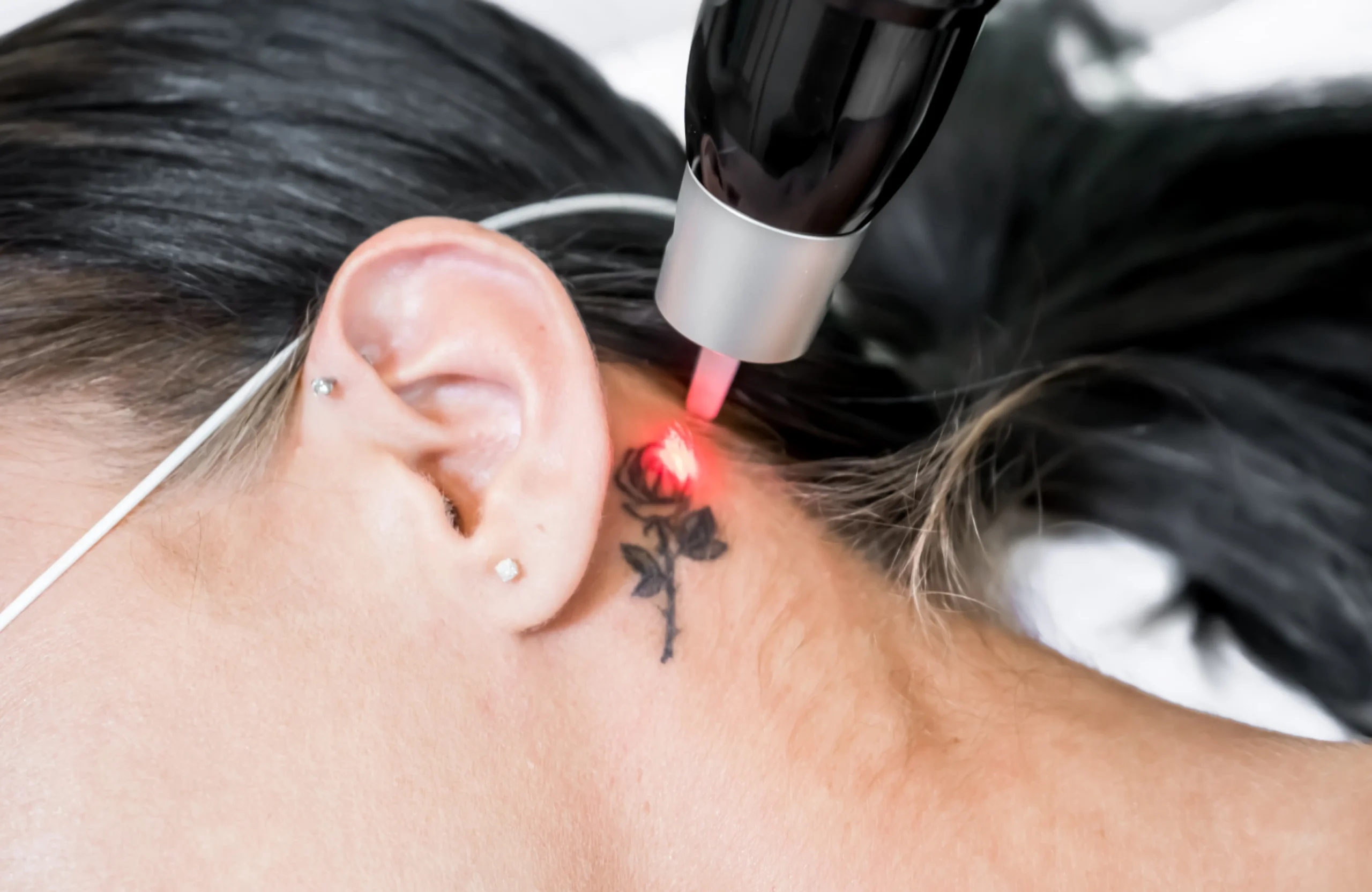 Tattoo Removal in Sainikpuri