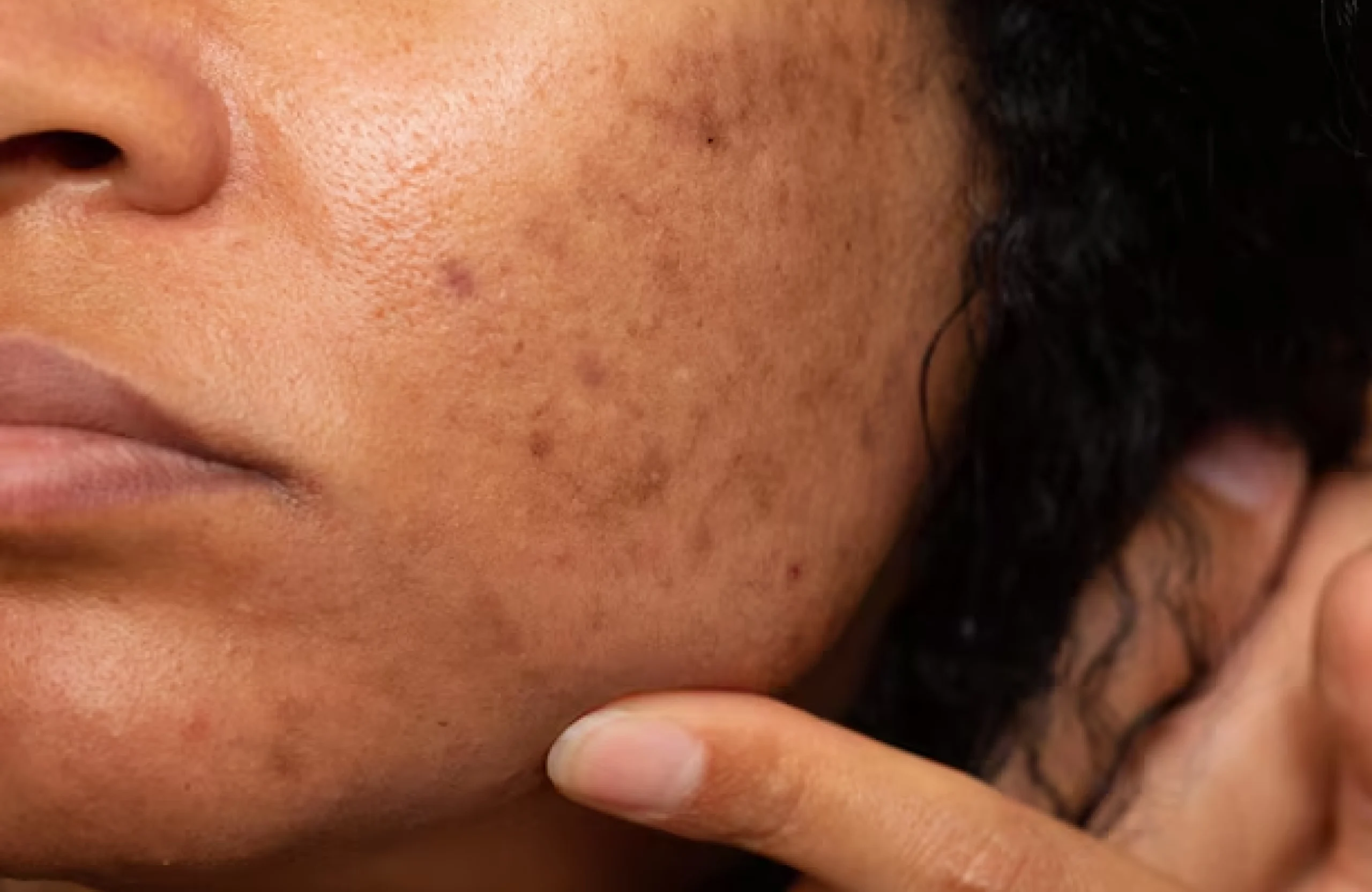 Hyperpigmentation Treatment in Sainikpuri