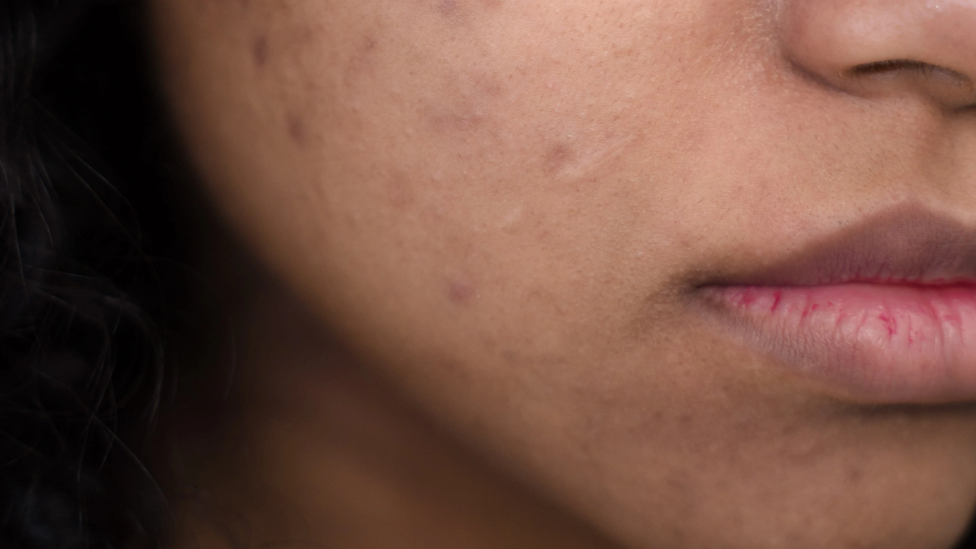 Acne Scars Treatment in Sainikpuri