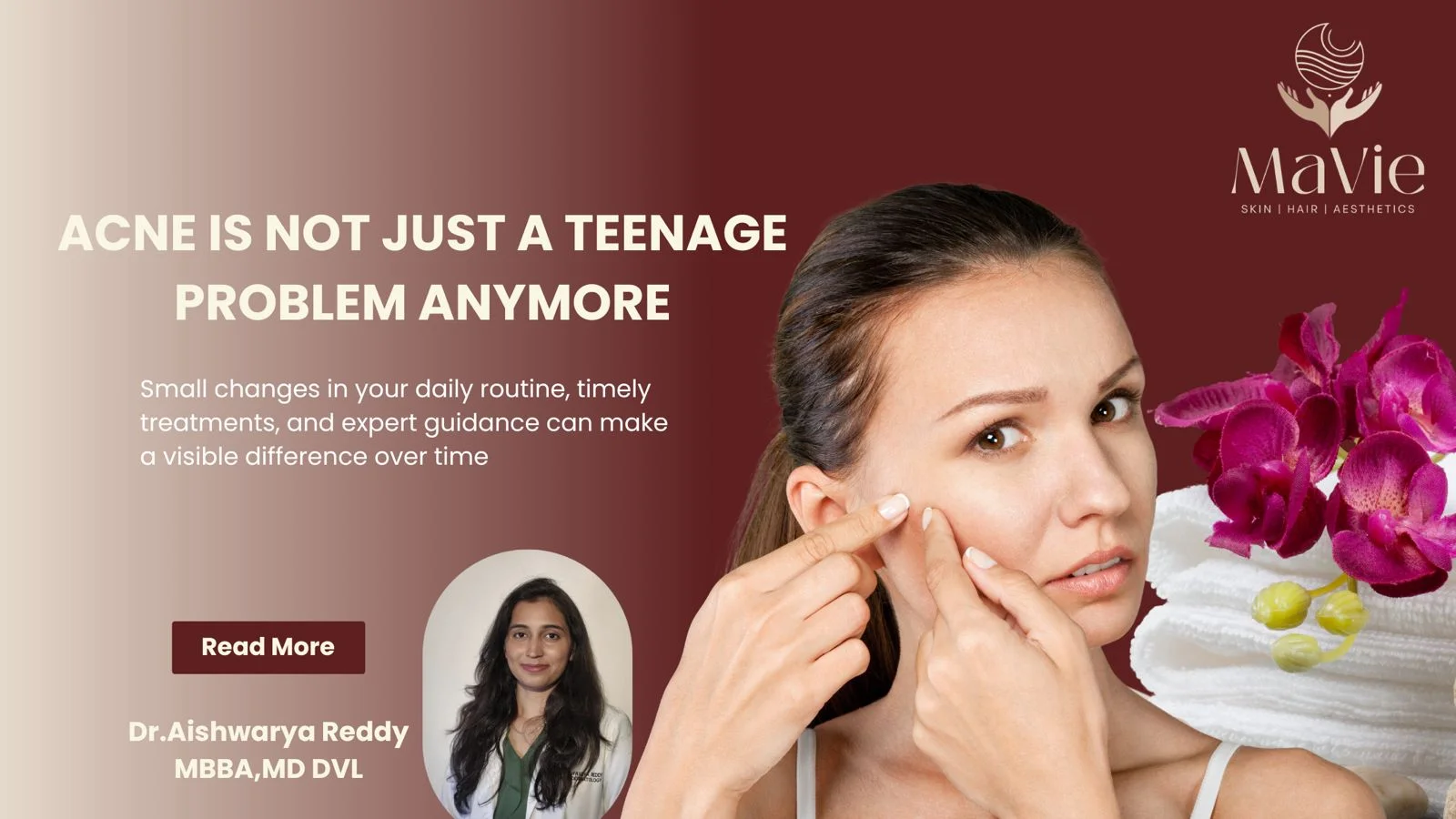 You are currently viewing Acne is not just a Teenage Problem anymore
